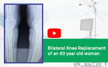 Bilateral Knee Replacement of an 83 year old woman